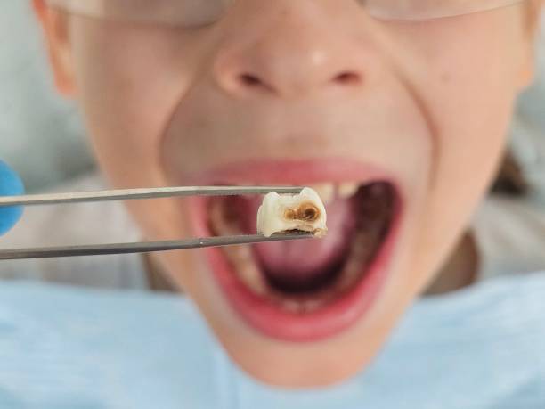 Best Emergency Tooth Extraction  in Harrison, NY